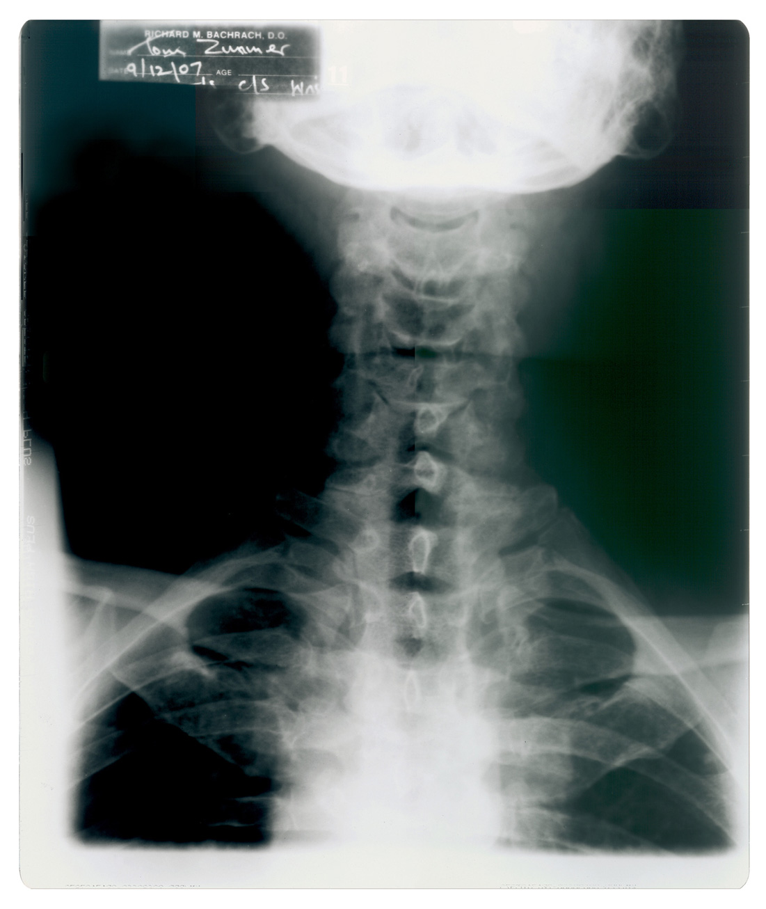 An X-ray of the upper thoracic region of Thomas Zummer. 