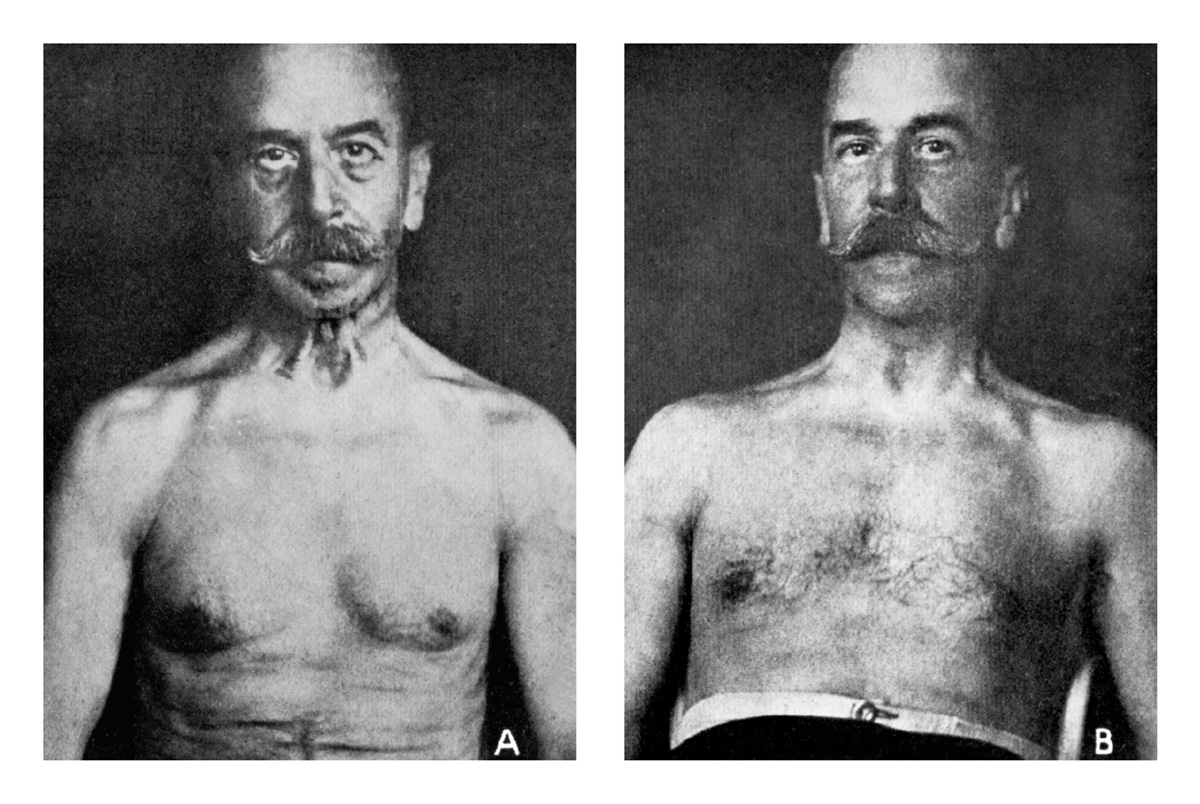 Two photographs showing a fifty-six-year-old man before and after the Steinach operation.