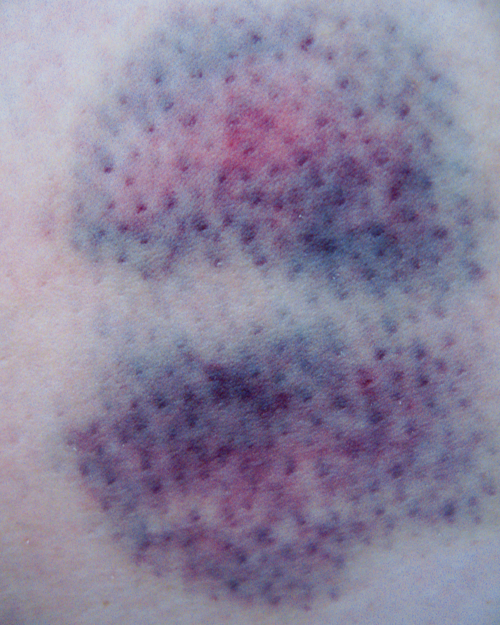 A close-up photograph of a bruise. 