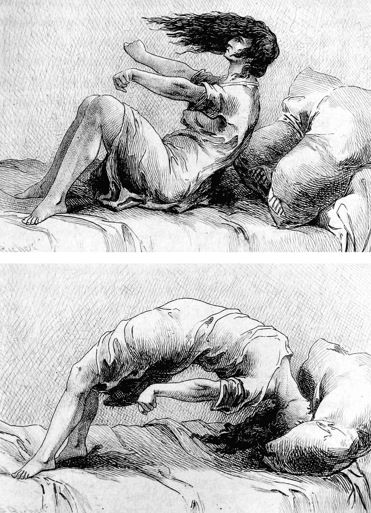 Two illustrations of a writhing hysteric in bed displaying the arc de cercle, from Paul Richer’s eighteen eighty-one work titled “Études cliniques sur l’hystéro-épilepsie, ou Grande hystérie”. French neurologist Jean-Martin Charcot, who named the pose, placed it within the “clownism” phase of his schema for how a hysterical attack proceeds. 