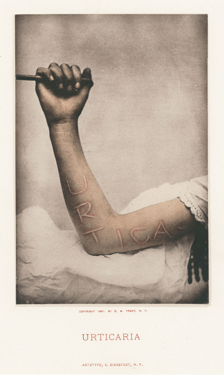 Labeled 1887 photograph by George Fox of the word Urticaria (an alternative for dermographia) written on patient’s arm.