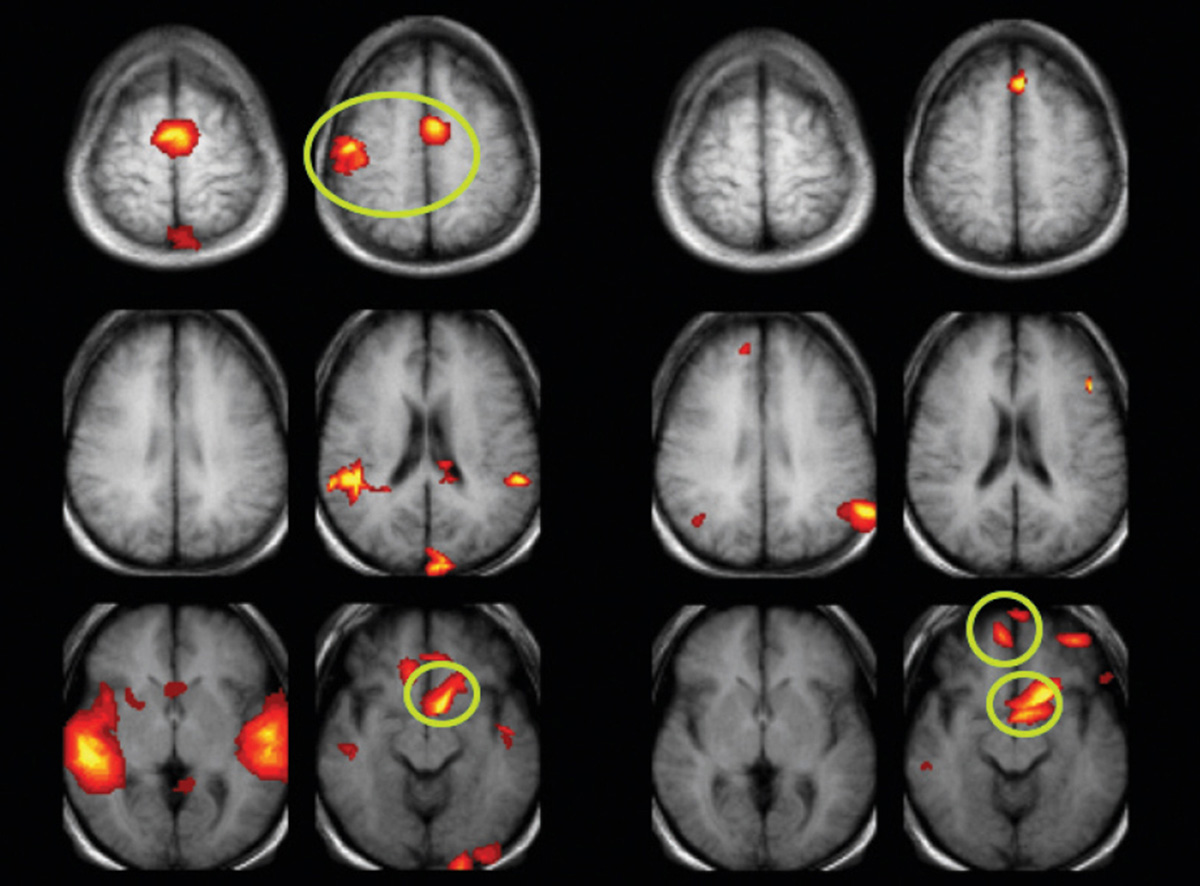 Two medical images marking areas of stimulation in the brain of a subject. The first highlights the subject’s reaction to silently laughing along with audio recordings of other people’s laughter, and the second shows the subject reacting to reading a joke book.