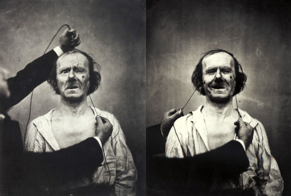 Guillaume Duchenne de Boulogne stimulating facial muscles with electrodes in order to illustrate certain expressions. The subject suffered from palsy and had no feeling in his face. In the right-hand photograph two different emotions are illustrated in a single expression: “moderate crying” on the left, and “fake laughter” on the right.