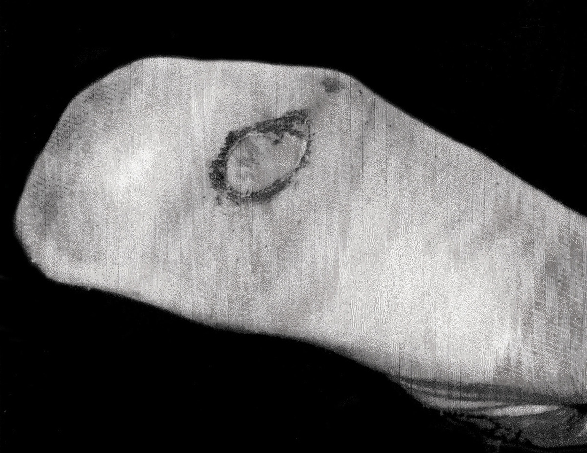 A photograph of John McLain’s sock, showing a hole created by an exiting lightning bolt.
