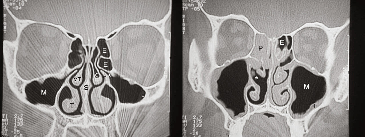 Two CT scans, one of which shows a patient with normal sinuses, and the other of which shows a patient with significant sinus disease. 