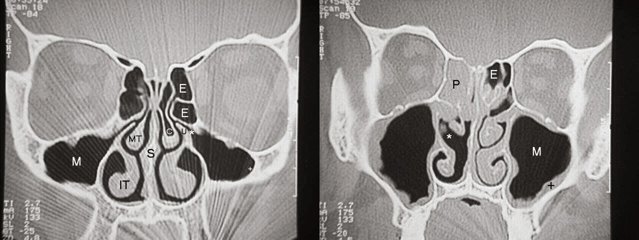 Two CT scans, one of which shows a patient with normal sinuses, and the other of which shows a patient with significant sinus disease.