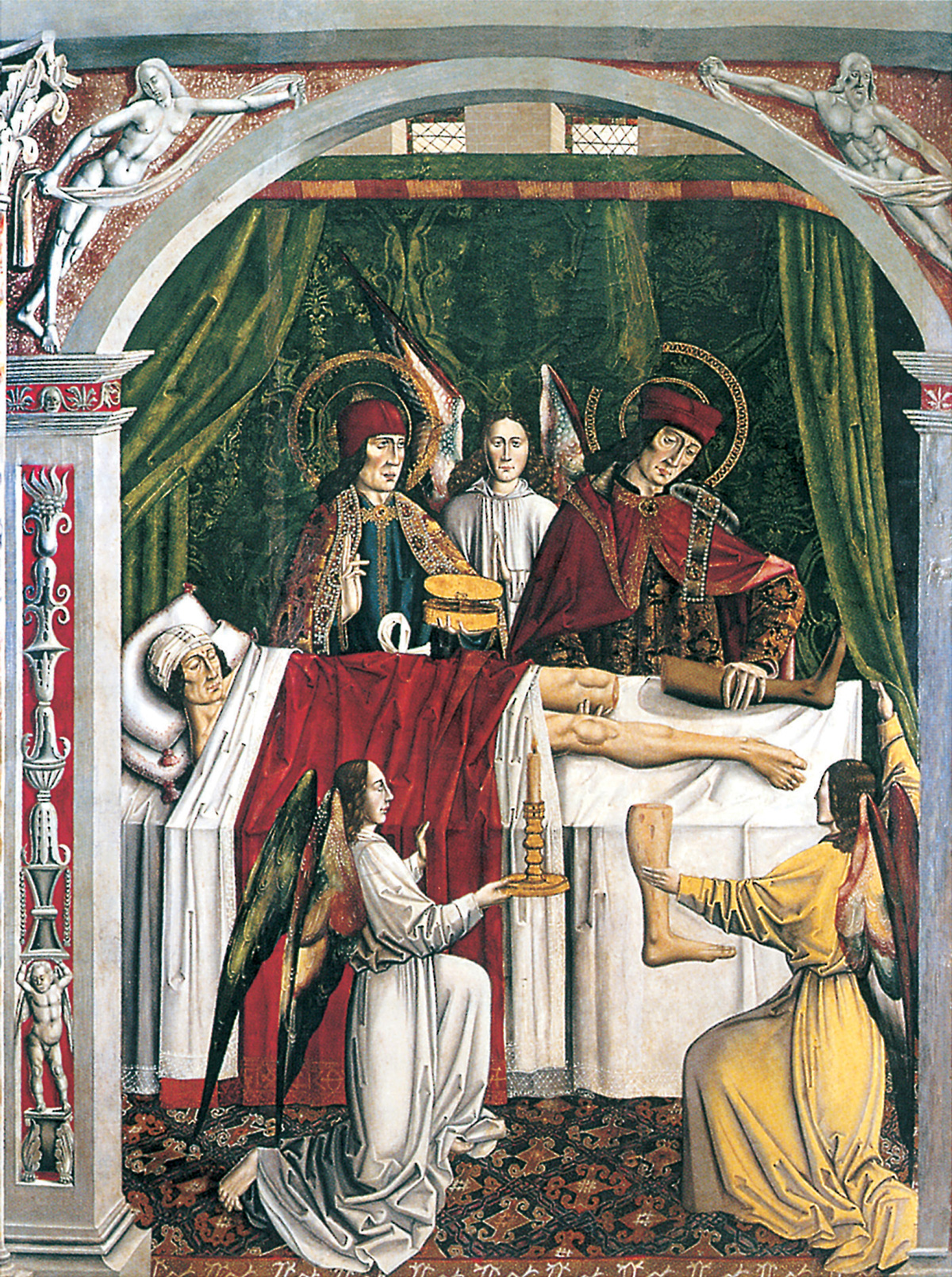 A painting attributed to Spanish painter Alonso De Sedano, circa fourteen ninety five, depicting saints Cosmas and Damian performing a miraculous surgery by amputating the ulcerated leg of a Christian and transplanting in its place the undiseased leg of a dead Moor. 