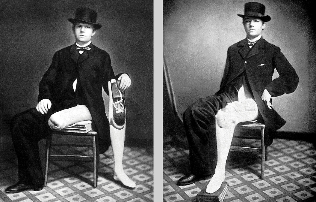 Two images. A photograph of a man missing the lower part of his left leg, and the same man wearing a prosthetic limb.