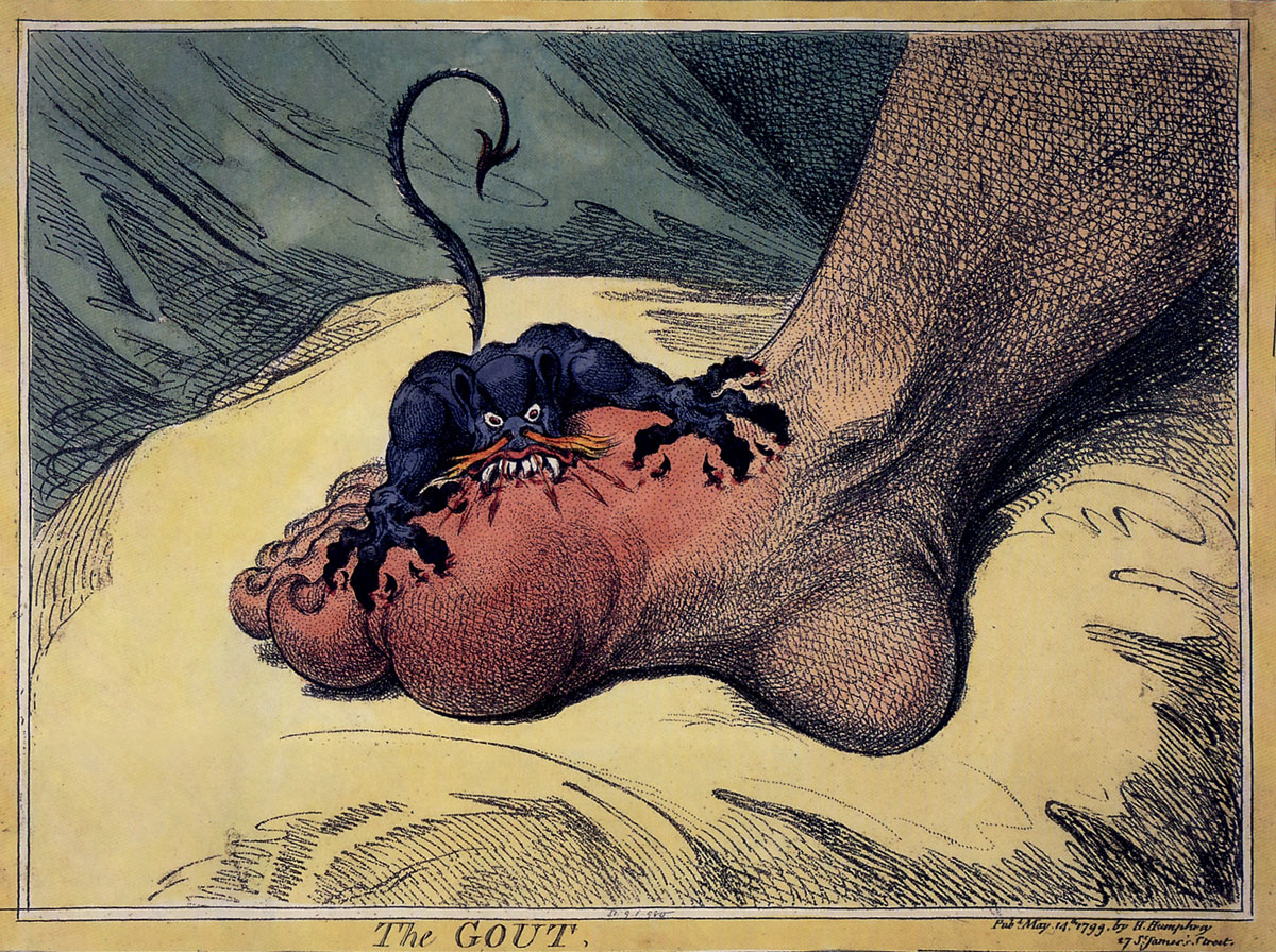 A 1799 hand-colored etching by James Gillray titled “The Gout.”