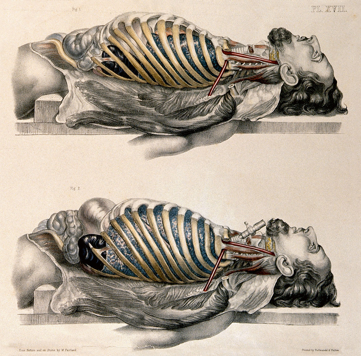 Lithograph from 1869 by William Fairland documenting the work of anatomist Francis Sibson. The two figures show the lungs after breathing out (above) and after breathing in (below). Courtesy Wellcome Library.