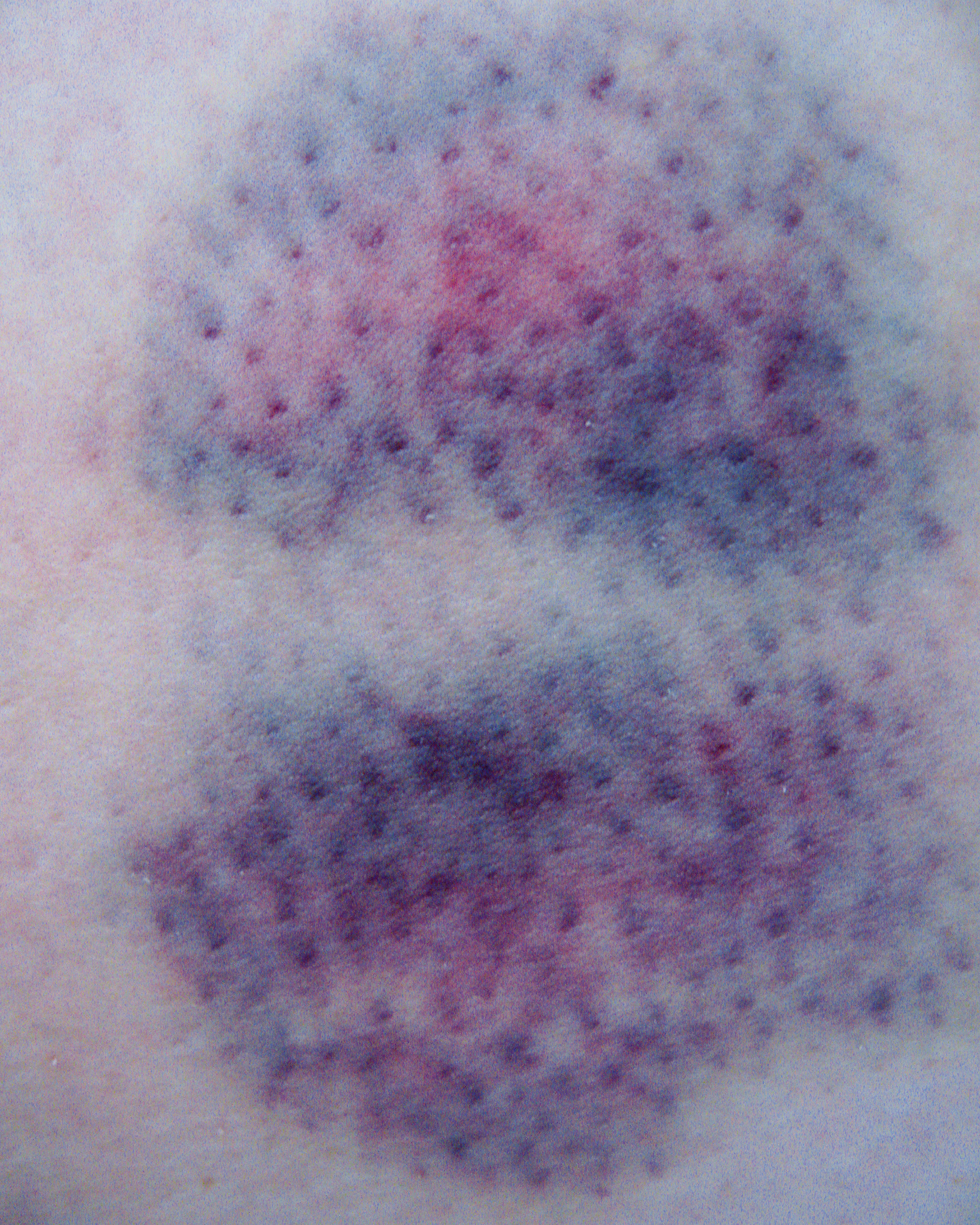 A close-up photograph of a bruise.