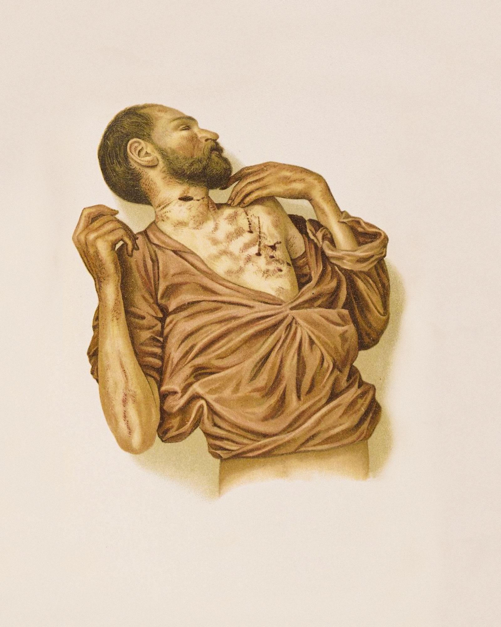 An eighteen ninety-eight forensic chromolithograph of a physician who committed suicide. That it was a case of suicide was demonstrated by, among other things, the proximity and symmetric disposition of the stab wounds.