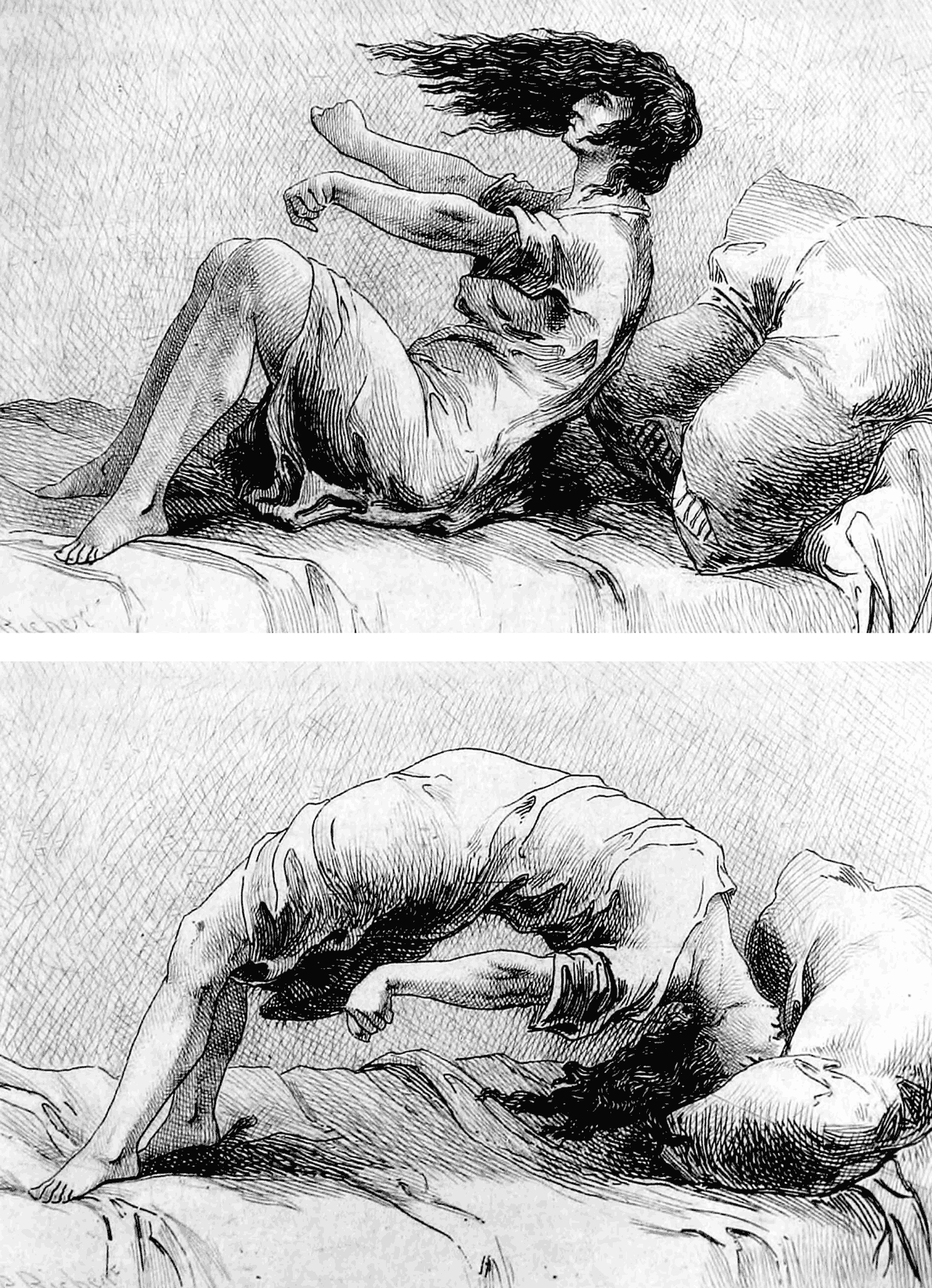 Two illustrations of a writhing hysteric in bed displaying the arc de cercle, from Paul Richer’s eighteen eighty-one work titled “Études cliniques sur l’hystéro-épilepsie, ou Grande hystérie”. French neurologist Jean-Martin Charcot, who named the pose, placed it within the “clownism” phase of his schema for how a hysterical attack proceeds.