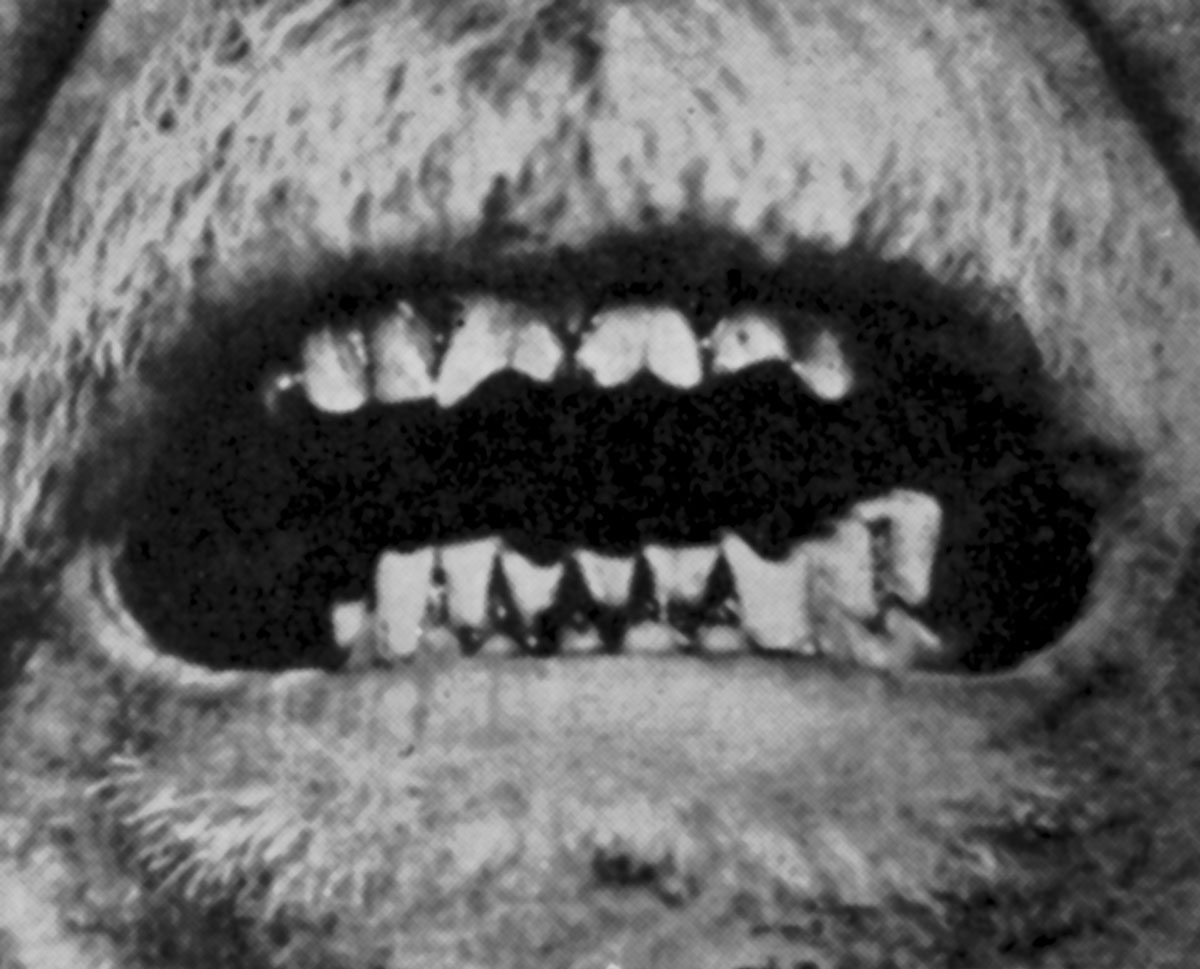 ­A photograph of a man's teeth from Francesco Ronchese's 1948 book “Occupational Marks and Other Physical Signs.”
